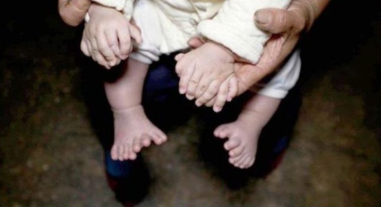 UNIK! Bayi Hong Hong Lahir dengan 31 Jari