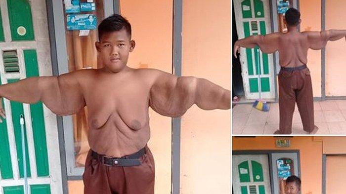 Mengenal Operasi Bariatrik yang Berhasil Turunkan 91 Kg Berat Badan Arya